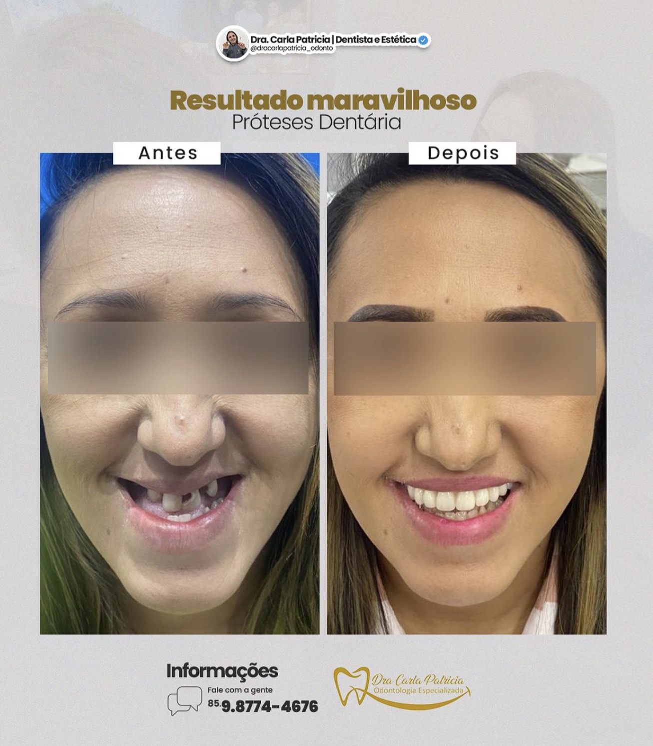Antes e depois de tratamento com prótese dentária